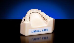 A lingual arch orthodontic appliance.