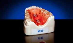 A Nord Appliance to treat a unilateral crossbite.